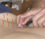 Acupuntura: uma das mais conhecidas terapias complementares